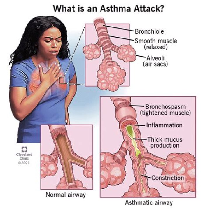 Can asthma cause syncope?
