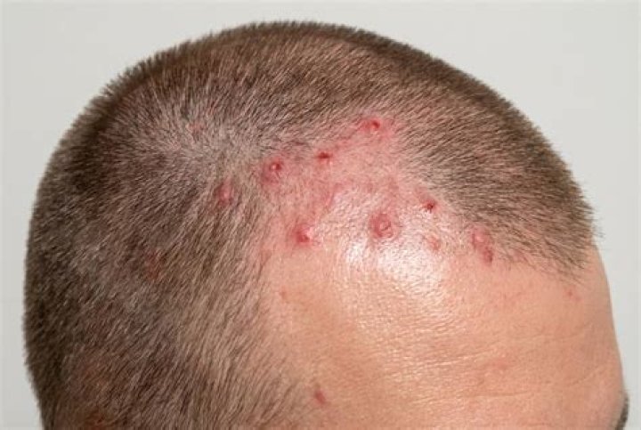 Can stress cause scalp rashes?