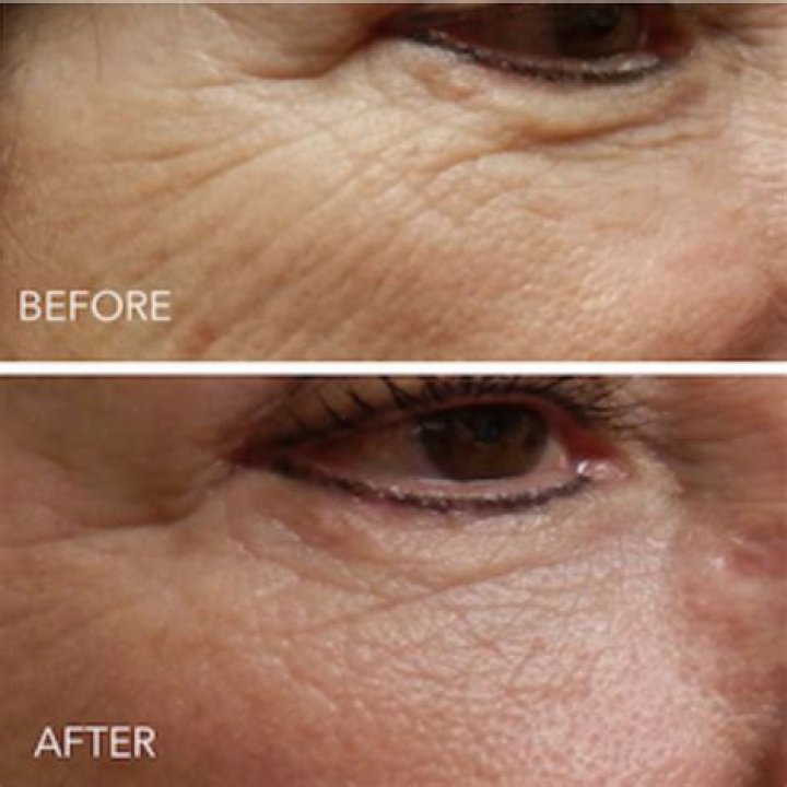 Can you use Differin for wrinkles?