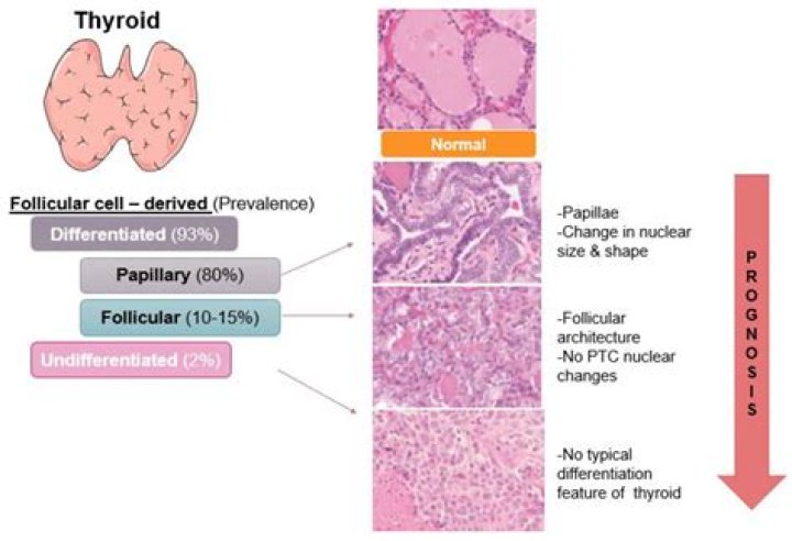 Do hurthle cells mean cancer?