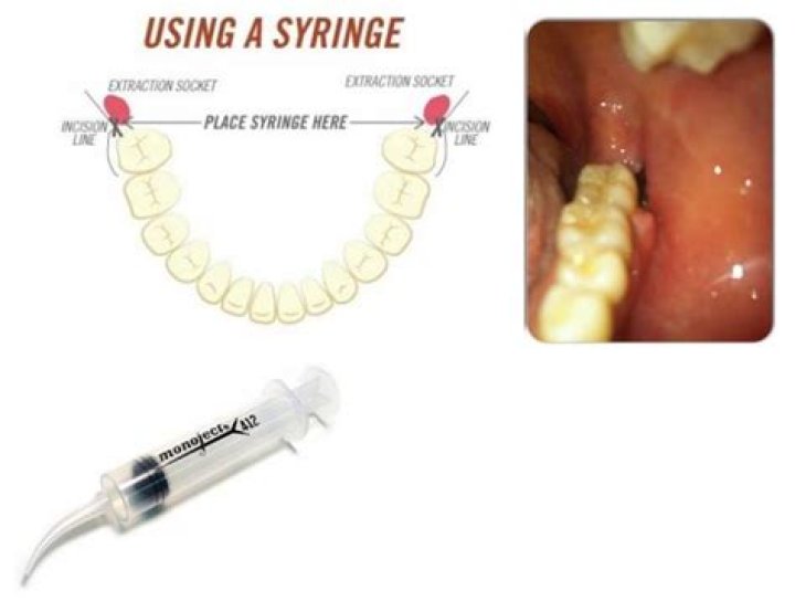 Do you have to syringe top wisdom teeth?