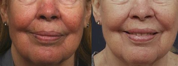 Does V beam laser tighten skin?