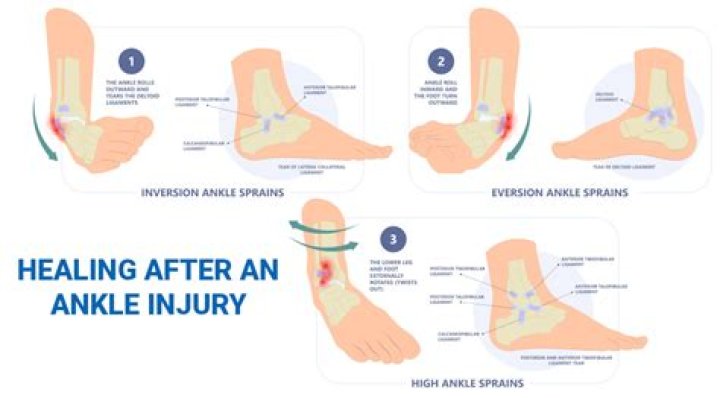 How long do snapped ankles take to heal?