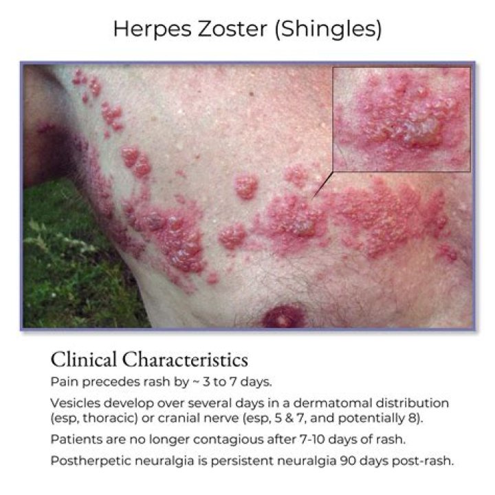 Is herpes keratitis the same as shingles?