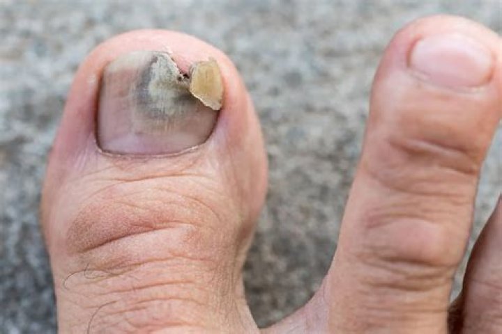 Should I be worried if my toenail falls off?