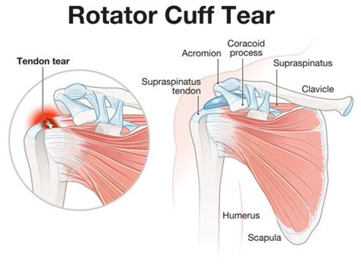 What anatomical structure is affected by rotator cuff injury?