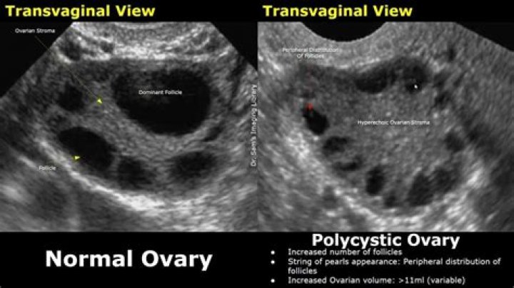What are spots on ovaries?