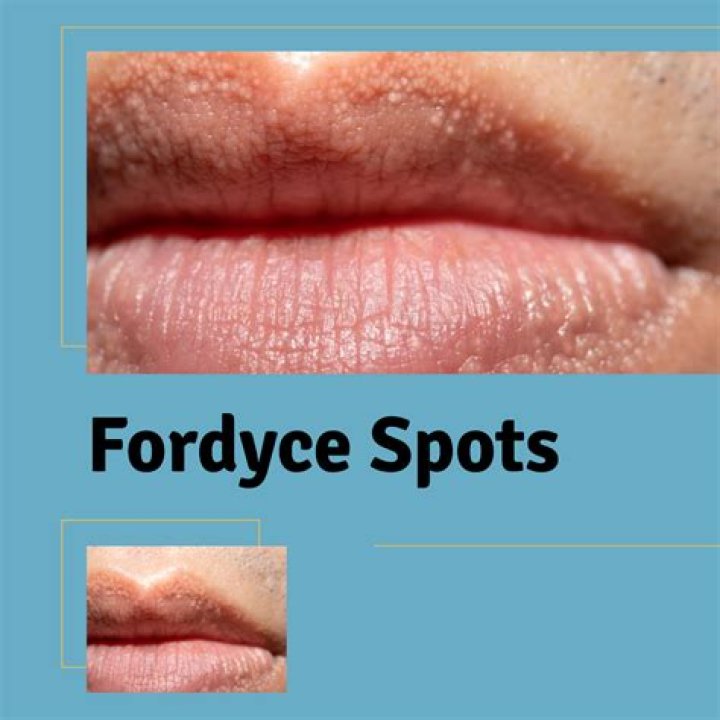 What triggers Fordyce spots on lips?