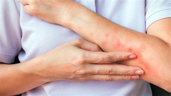 Why is my mosquito bite so painful?